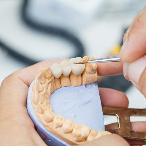 Dental bridge being crafted??
